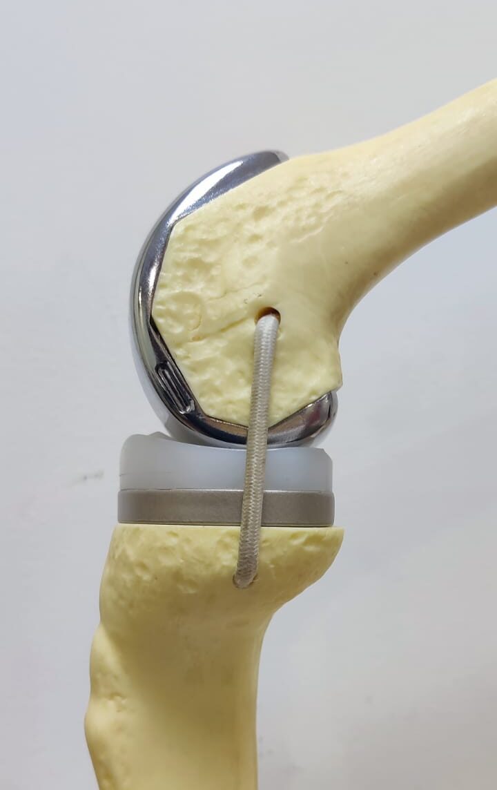 Knee Replacement treatment