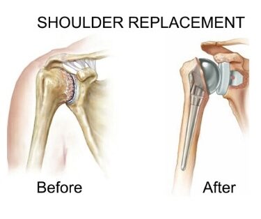 Shoulder Replacement surgery After & Before