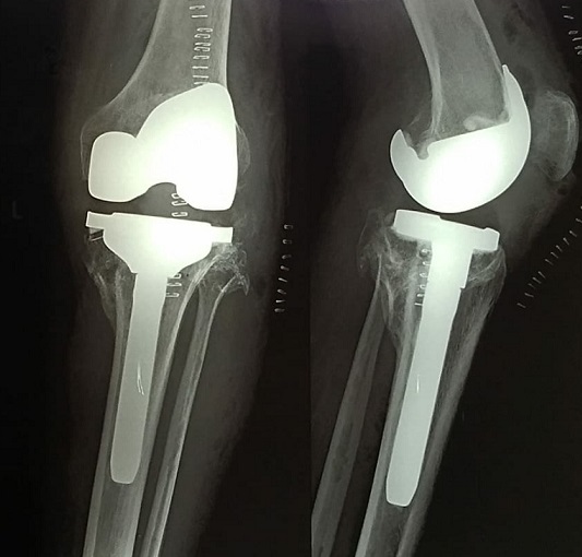 Total Knee Replacement (TKR) Using Stryker Triathlon System Dr
