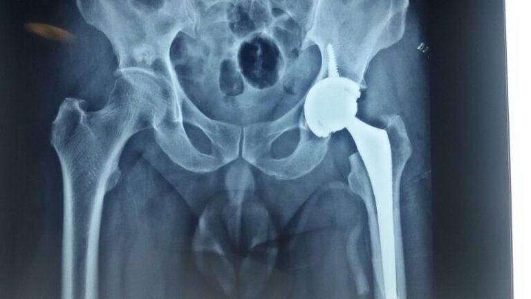 Best Hip Replacement Surgery in Bangalore, India | Dr. Chethan