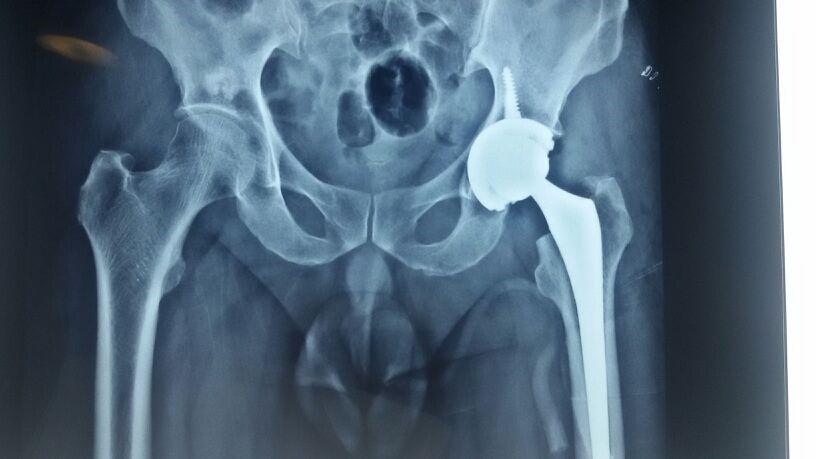 Advantages of Hip Replacement Surgery