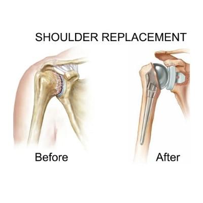 shoulder replacement