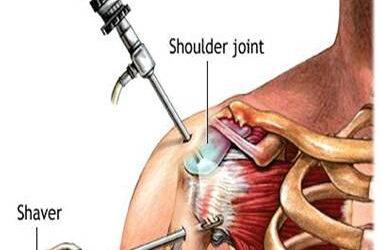 Shoulder Arthroscopy Procedure and Recovery