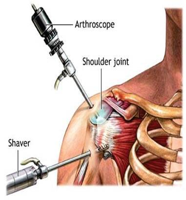 shoulder arthroscope