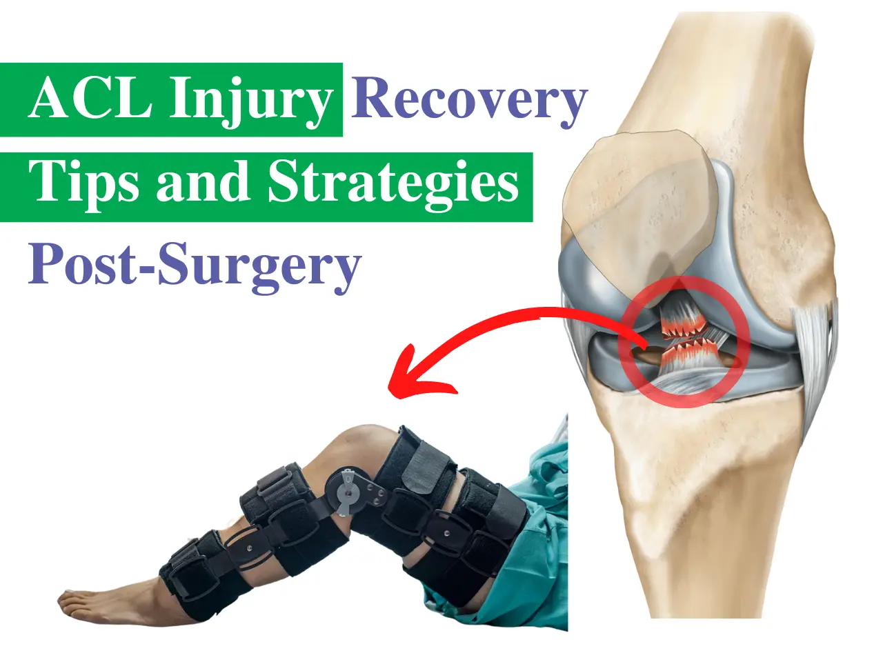 ACL Injury Recovery tips