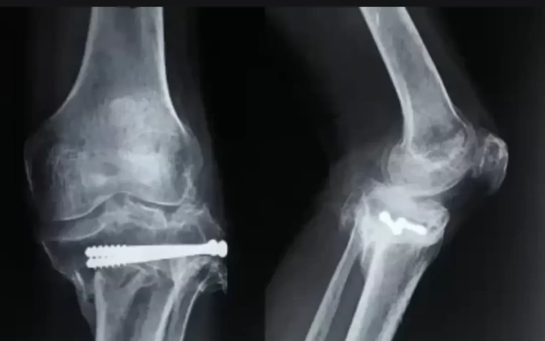 Total Knee Replacement (TKR) Using Stryker Triathlon System