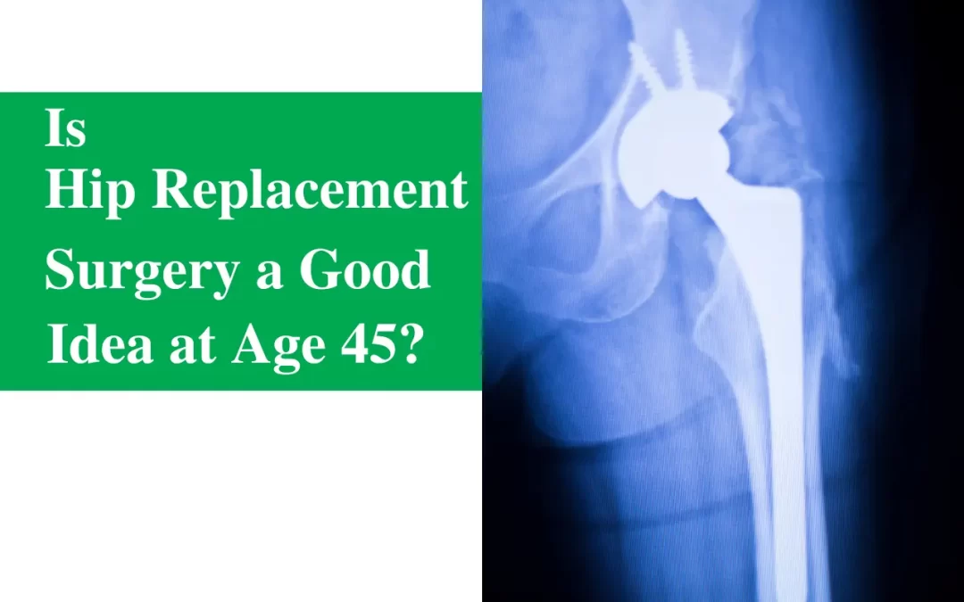 Is Hip Replacement Surgery a Good Idea at Age 45?