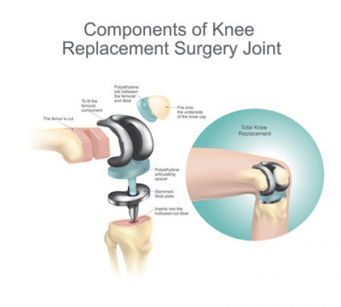 Components of knee replacement surgery