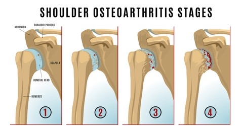 Shoulder osteoarthritis stages