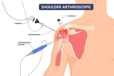 shoulder arthroscopy