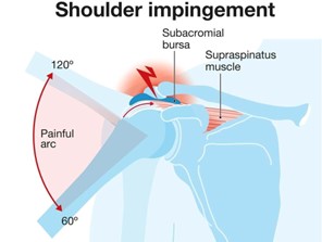 Shoulder impingement