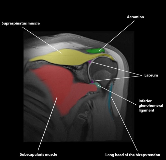 Role of MRI in Shoulder Joint