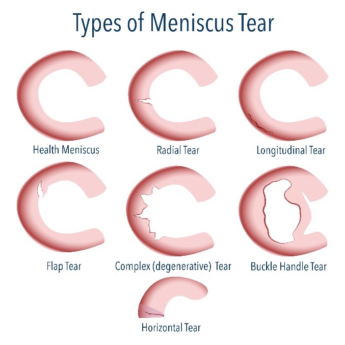 Types of Meniscus Tear