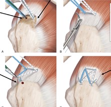 arthroscopic repair