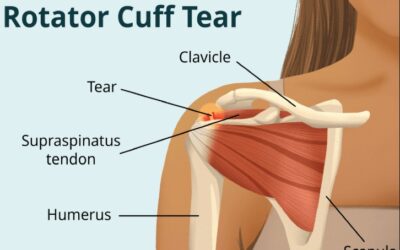 From Injury to Recovery: Understanding Rotator Cuff Damage