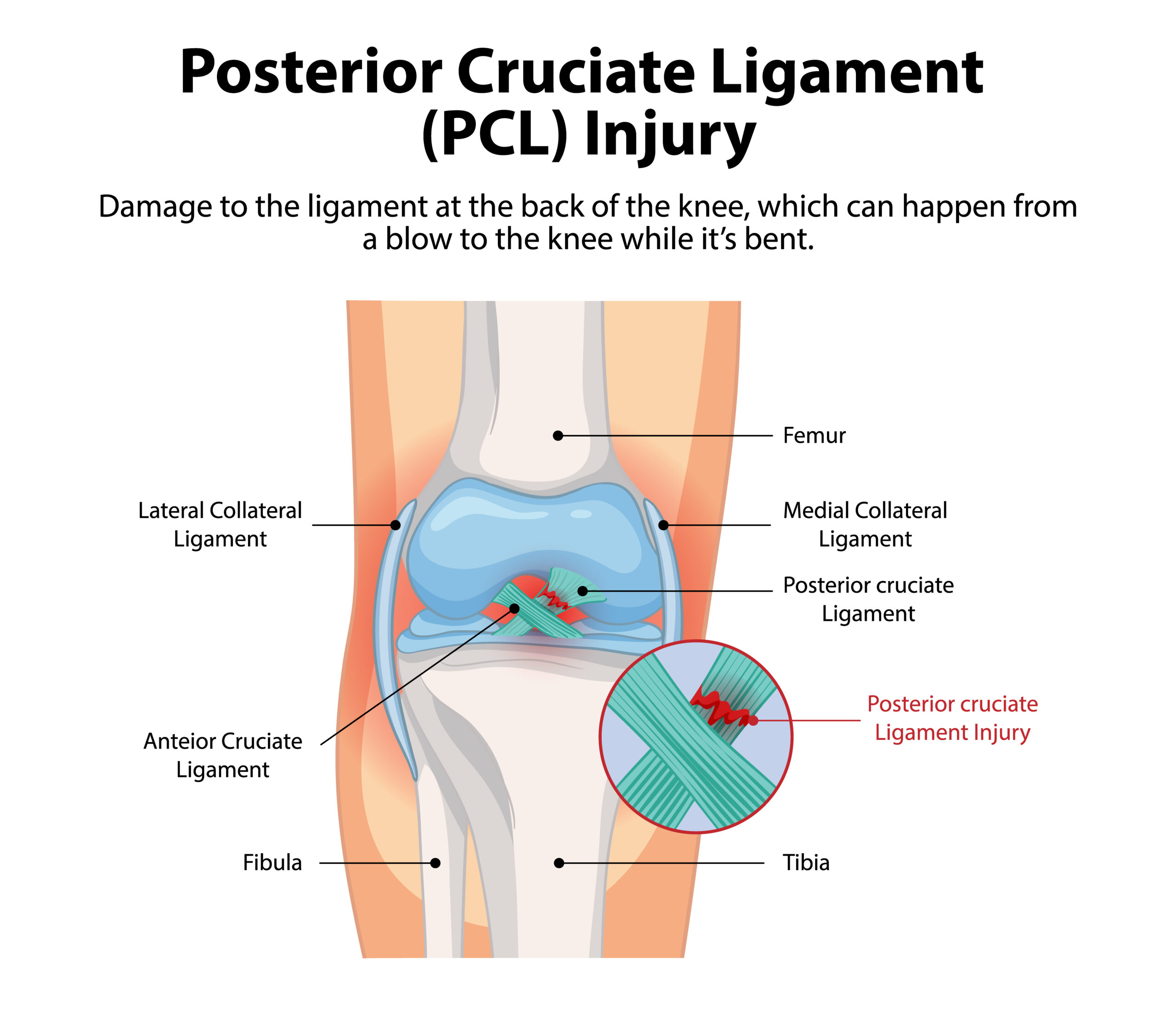 Meniscus Tear: Repair vs Trimming (Meniscectomy) – Choosing the Right Treatment