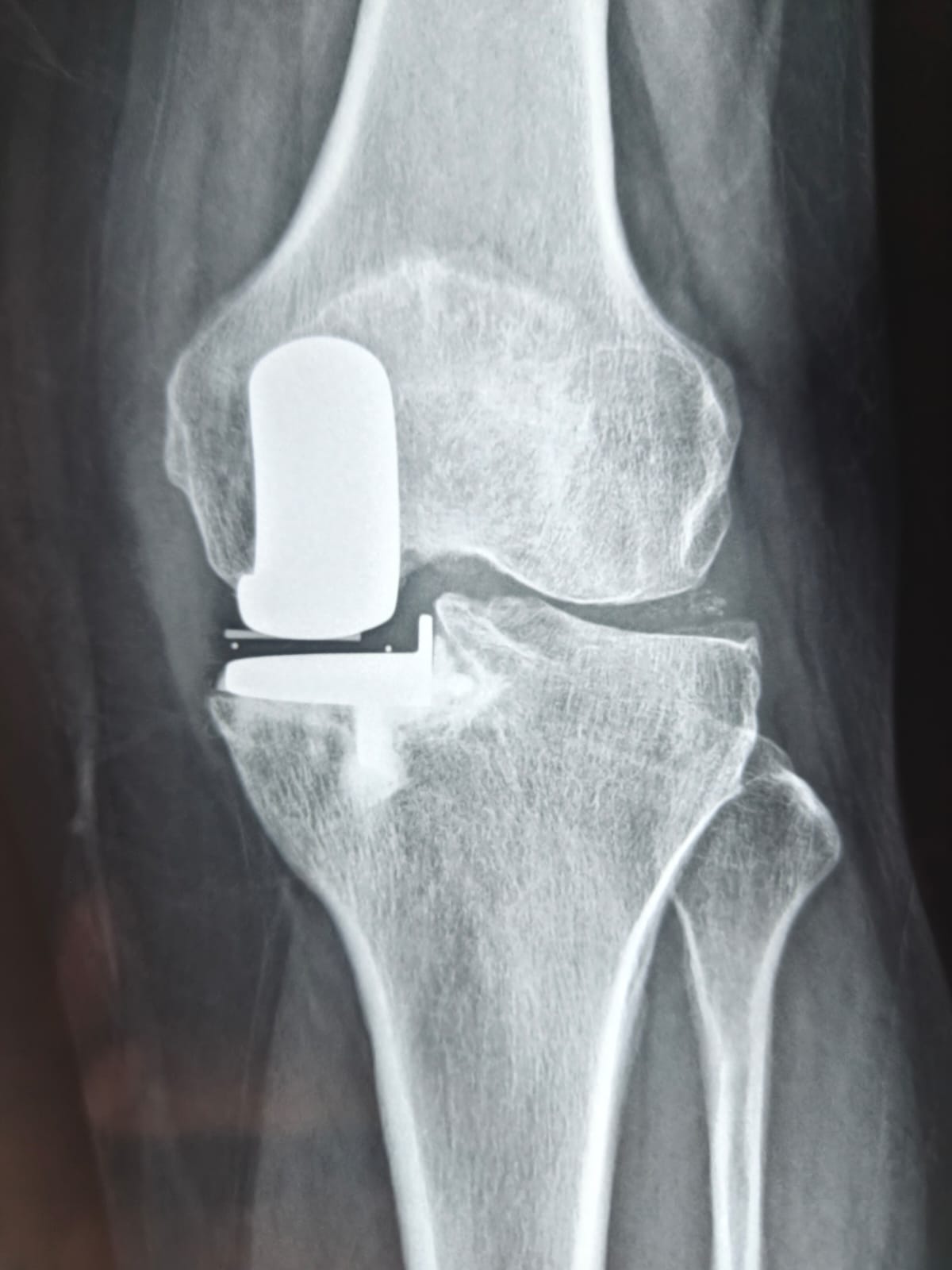 Role of MRI in Shoulder Joint
