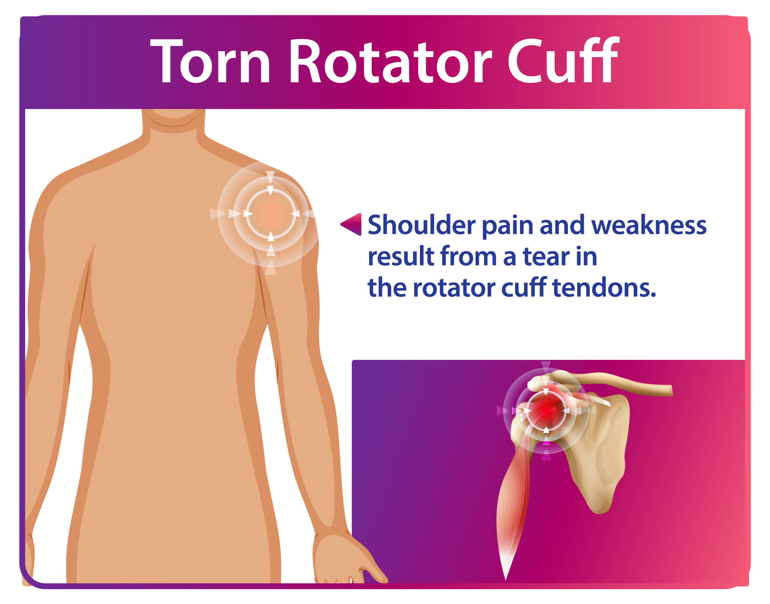 Rotator Cuff Injury Treatment in Bangalore